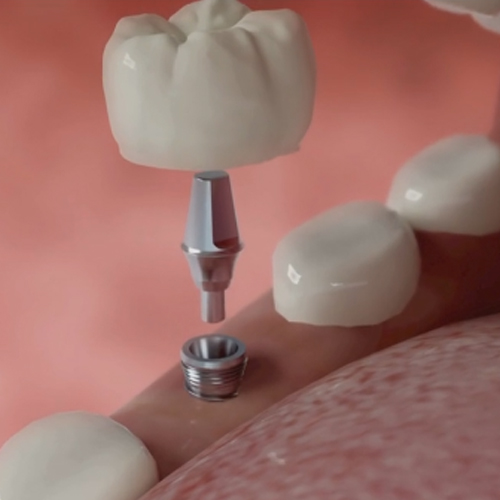 Dental Implants Lucknow