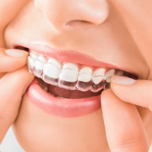 Invisalign Clear Aligners Lucknow