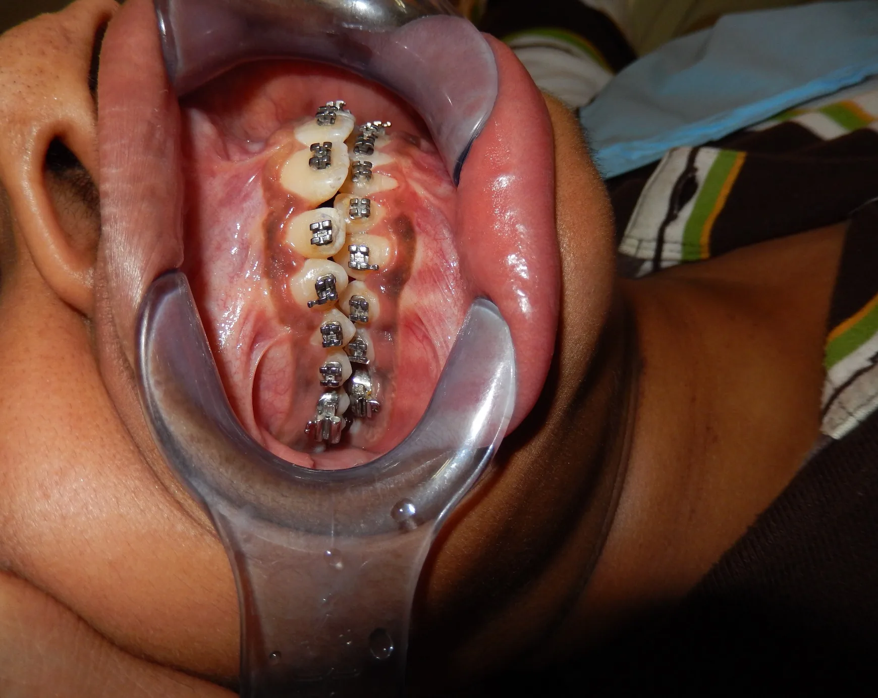 Case 1 — After Treatment