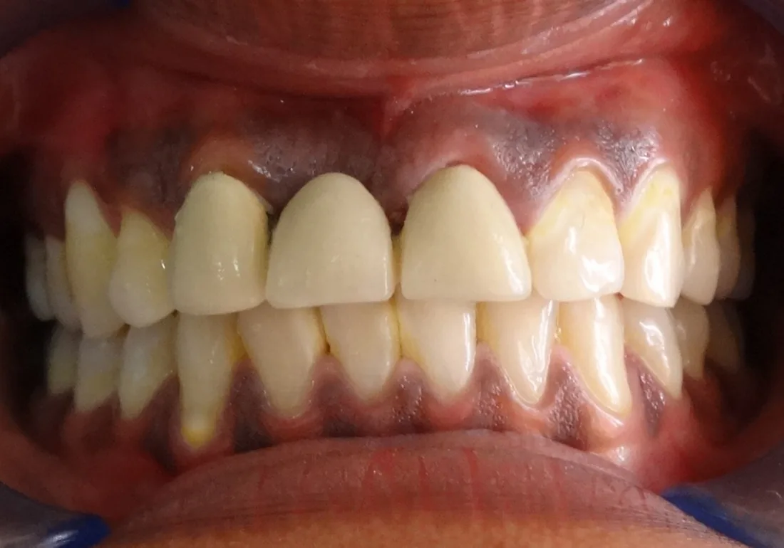 Case 4 — After Treatment