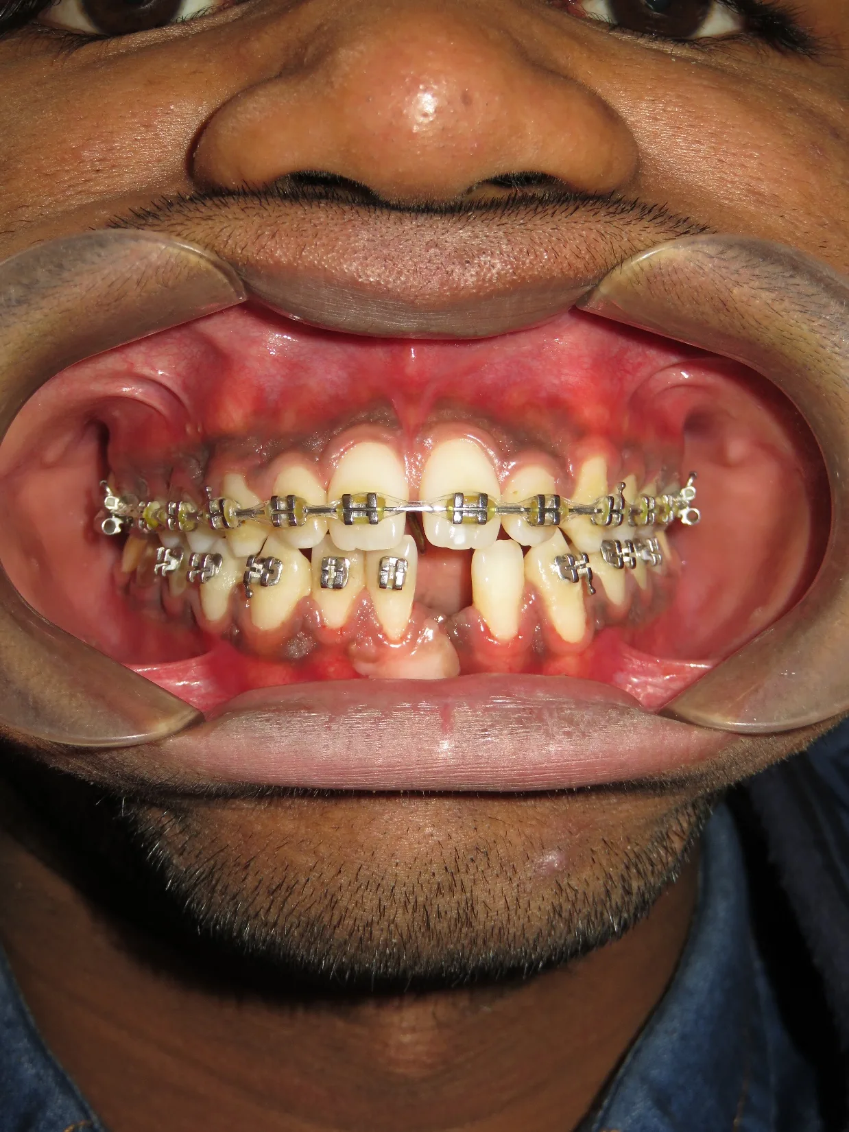 Case 5 — After Treatment