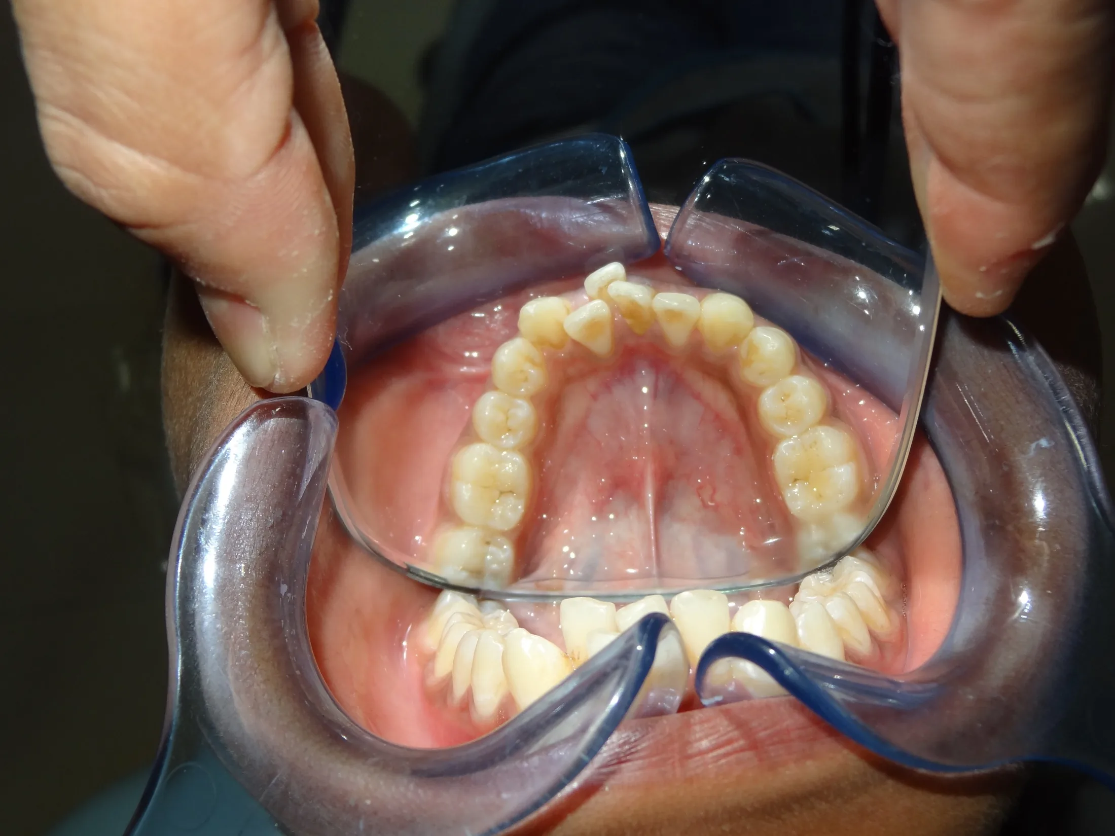 Case 2 — Before Treatment