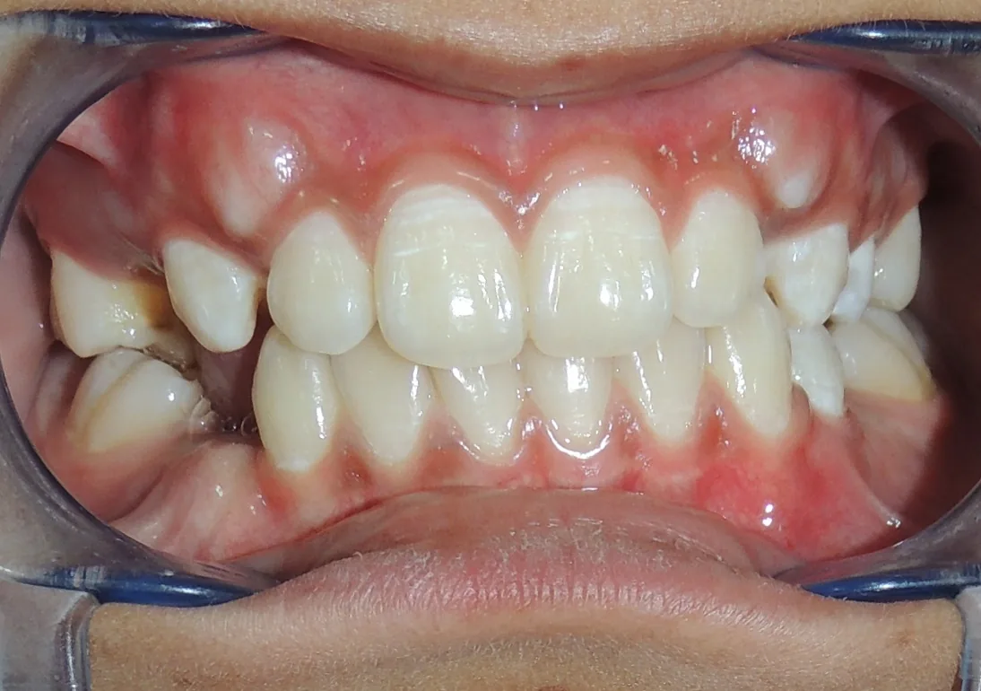 Case 3 — Before Treatment