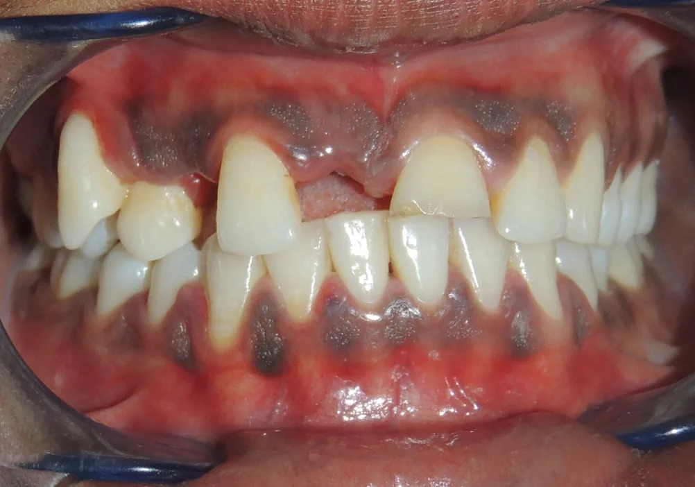 Case 4 — Before Treatment