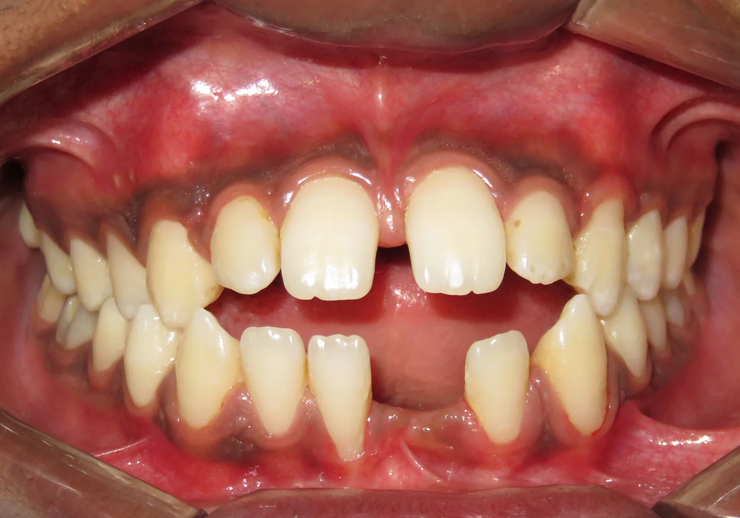 Case 5 — Before Treatment