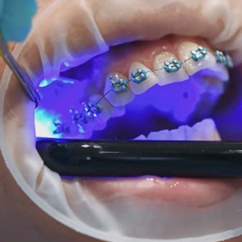 Orthodontic Braces Treatment Lucknow