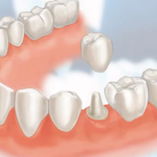 Dental Crowns and Dentures Lucknow
