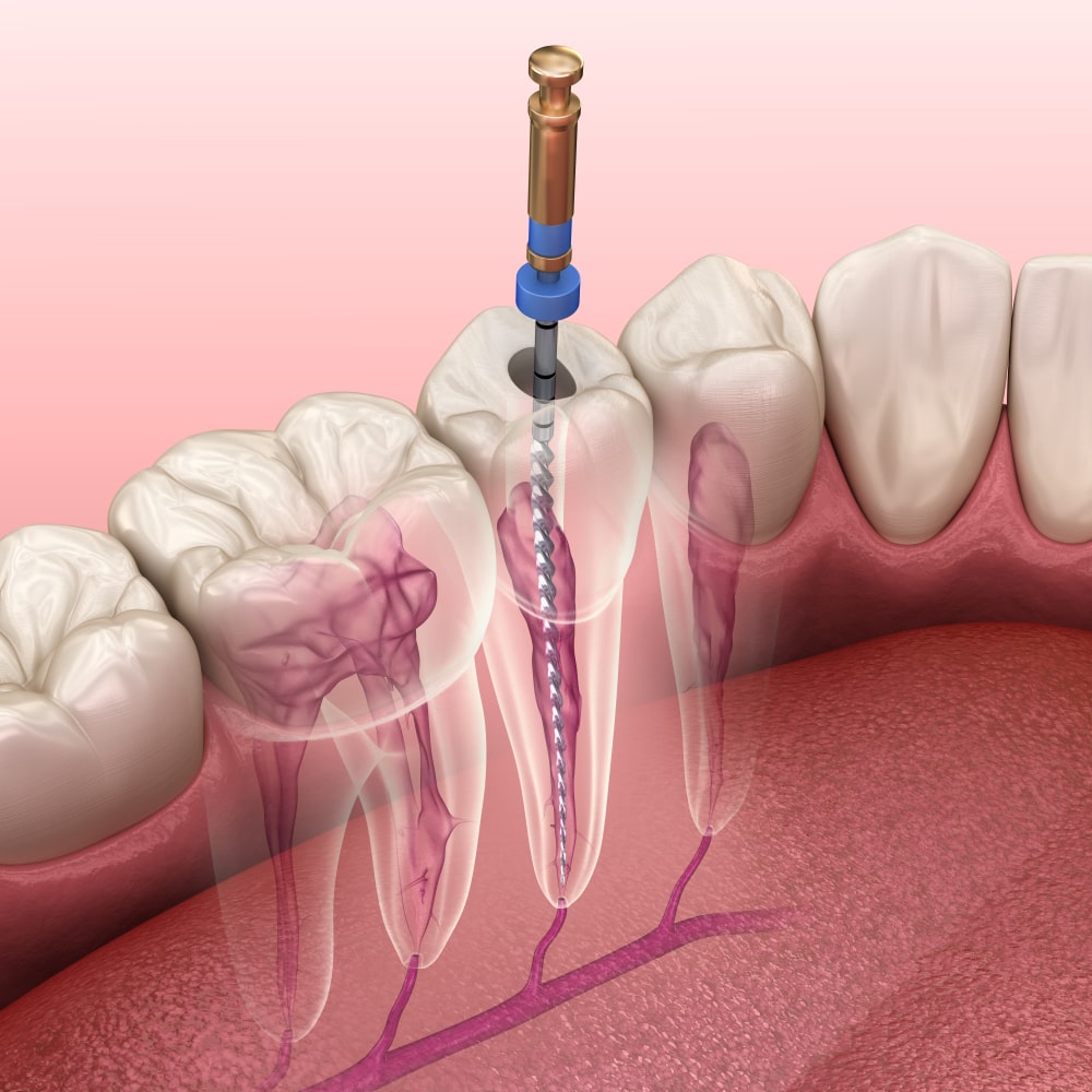 Root Canal Treatment Lucknow