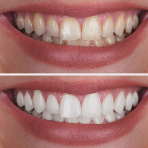 Teeth whitening Lucknow